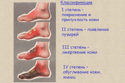 Степени ожогов кипятком