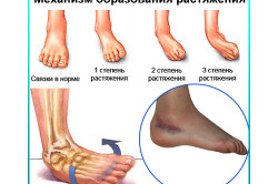 Механизм образования и степени тяжести растяжения