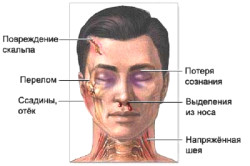 Основные признаки черепно-мозговой травмы