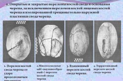 Открытые и закрытые переломы костей свода и основания черепа