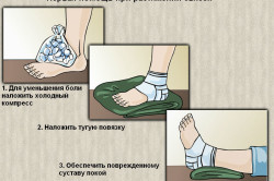 Первая помощь при растяжении связок