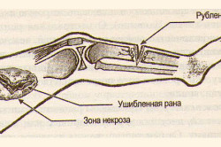 Рубленая и ушибленная раны