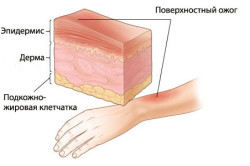 Схема поверхностного ожога