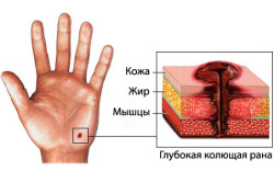 Схематическое изображение колотой раны
