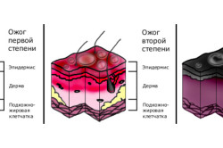 Степени ожогов