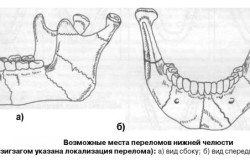 Возможные места перелома челюсти