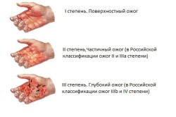Международная классификация ожогов