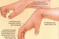 Диагностика вывиха кисти