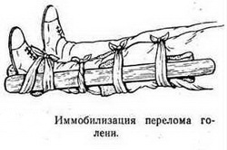 Иммобилизация при переломе голени