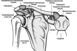 Растяжение связок ключицы