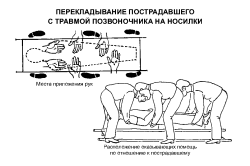 Правильное перекладывание пострадавшего с травмой позвоночника на носилки