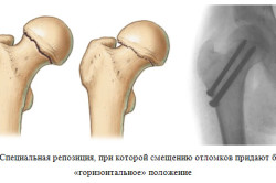 Схема перелома шейки бедра
