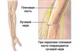 Схема перелома