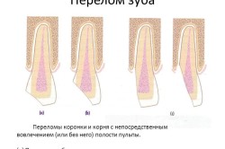 Перелом зуба