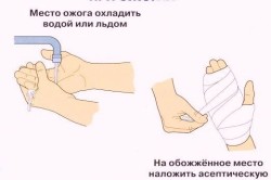 Правила оказания первой помощи при ожогах