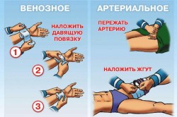 Первая помощь при кровотечениях