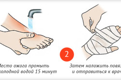 Первая помощь при ожоге горячим подсолнечным маслом