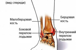 повреждения голеностопного сустава