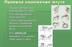 Правила наложения жгута