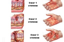 Степени ожогов