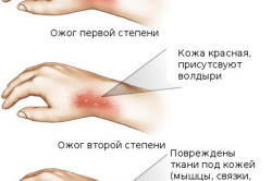 Степени ожогов