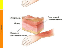 Степени тяжести ожогов