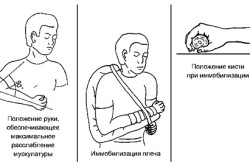 Транспортная иммобилизация при переломе костей предплечья
