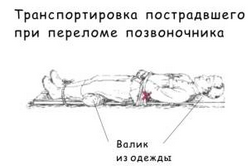 Транспортировка пострадавшего при переломе позвоночника