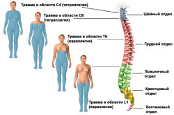 Поражения при травмах спинного мозга