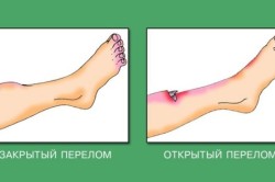 Виды переломов