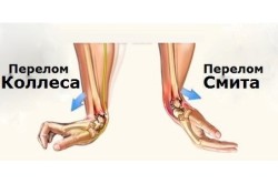 Схема перелома Коллеса и Смита