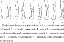 Виды переломов трубчатых костей