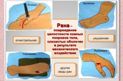 Виды ран