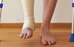 Как лечить перелом со смещением лодыжки