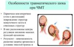 Необходимая первая помощь при черепно мозговой травме