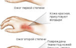 Эффективная мазь от ожогов